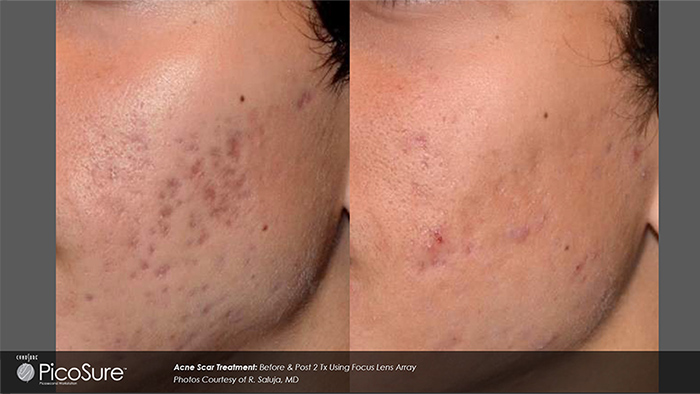 Picosure Before &amp; After Photo