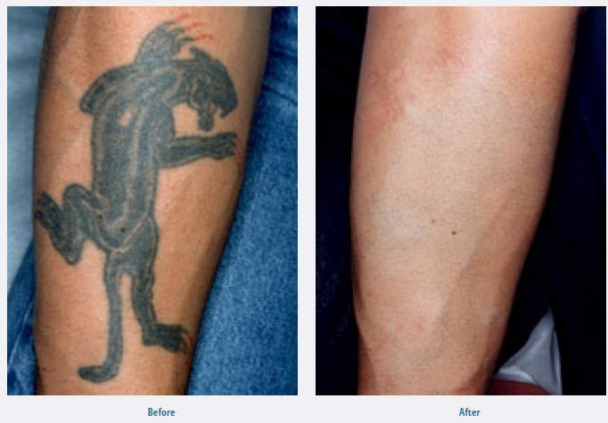 Tattoo Removal Connecticut (Now with the revolutionary ...