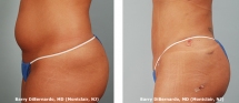 before_after_body-jet_2