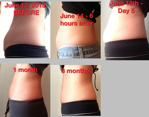 Follow One Patient's CoolSculpting® Journey CoolSculpting 