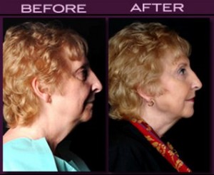 Facelift Alternatives Guilford at Langdon Center