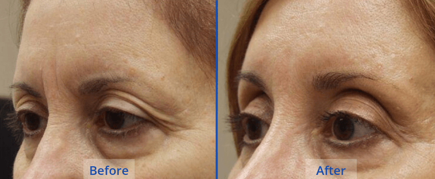 Brow-Lift-Guilford