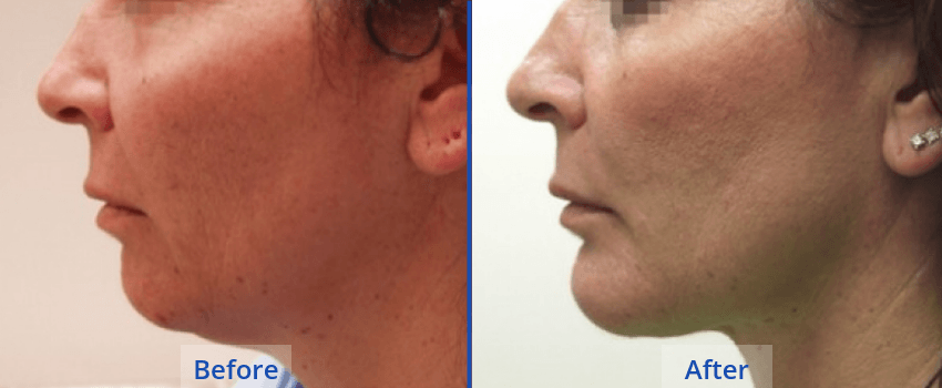 Chin-implant-guilford