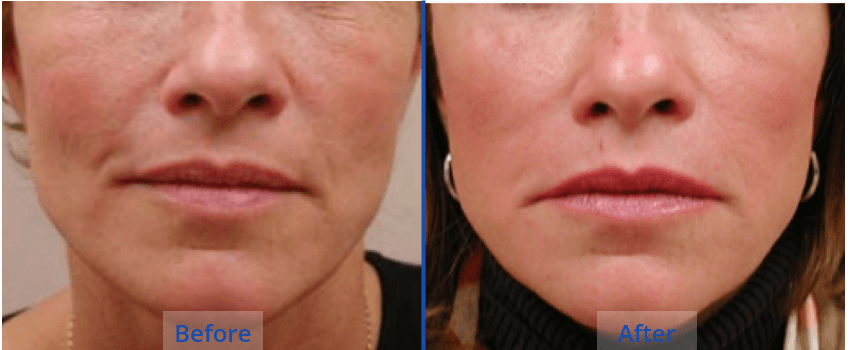 Facial-Fat-Transfer-Guilford Facial-Fat-Transfer-Guilford