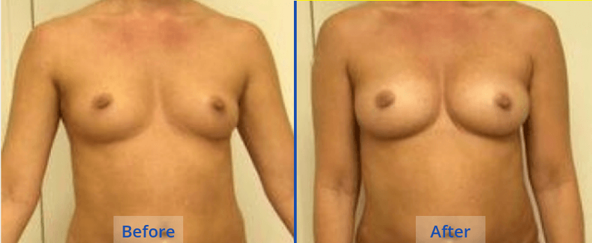 Natural Breast Augmentation Guilford