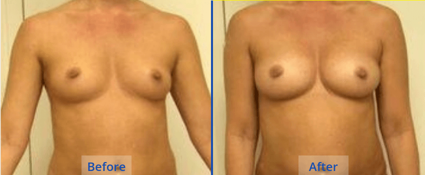 Natural Breast Augmentation Guilford - the Langdon Center Natural Breast Augmentation Guilford