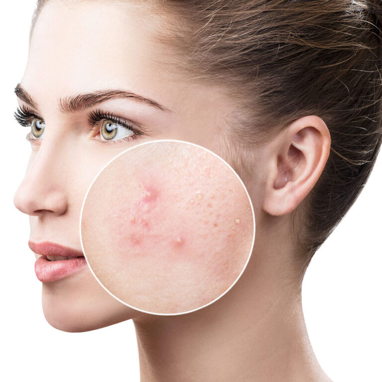 Top Avoidable Causes of Acne