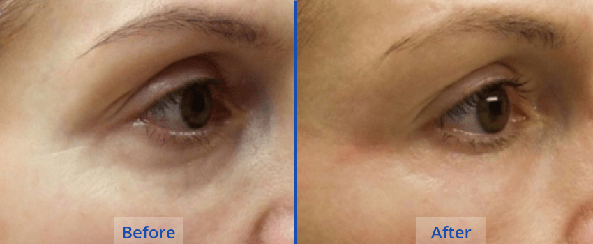 natural-eyelid-lift-guilford