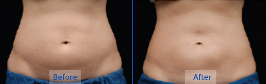 Coolsculpting-guilford (1) - the Langdon Center Coolsculpting-guilford (1)