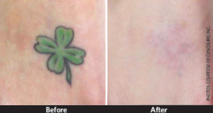PicoSure completely removes tattoos in less time and with less pain!