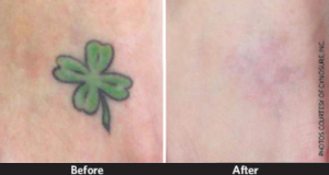 PicoSure completely removes tattoos in less time and with less pain! Laser Tattoo Removal Guilford