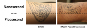 Tattoo Removal the Langdon Center