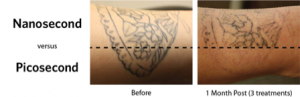 Tattoo Removal The Langdon Center Laser Tattoo Removal Guilford