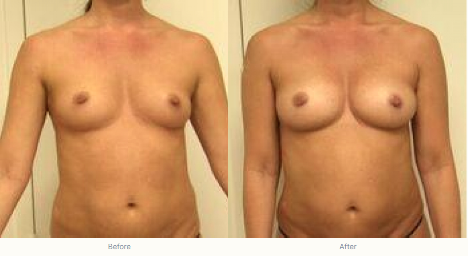 They’re Just Like Us! Natural Breast Augmentation - The Shoreline Center for Laser & Cosmetic Surgery Natural breast augmentation at guilford & madison connecticut