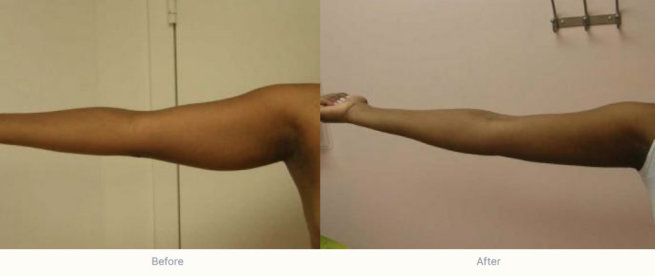 SmartLipo™ Laser Liposuction in New Haven County, Fairfield County & Middlesex County - The Shoreline Center for Laser & Cosmetic Surgery Smartlipo™ at guilford & madison connecticut