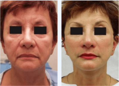 facelift-before-after-guilford-ct-langdon-Center