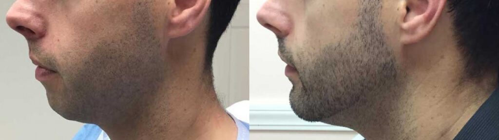 Chin Implants at Guilford & Madison Connecticut Chin Implants Create a More Masculine