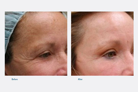 Browlift-before/after Guilford