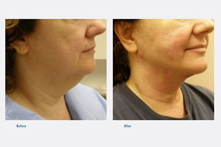 lipo-neck-and-jowl New Haven lipo-neck-and-jowl New Haven