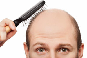 no-hair Hair Transplant Guilford