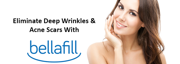 Bellafill: the Newest Injectable Filler