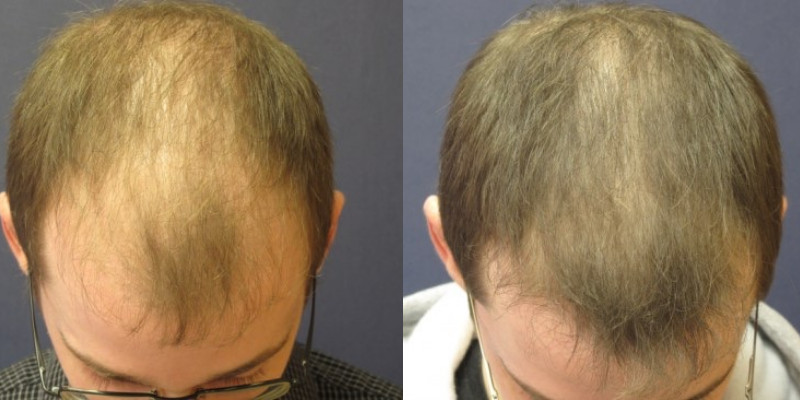 Hair Restoration With PRP | The Langdon Center