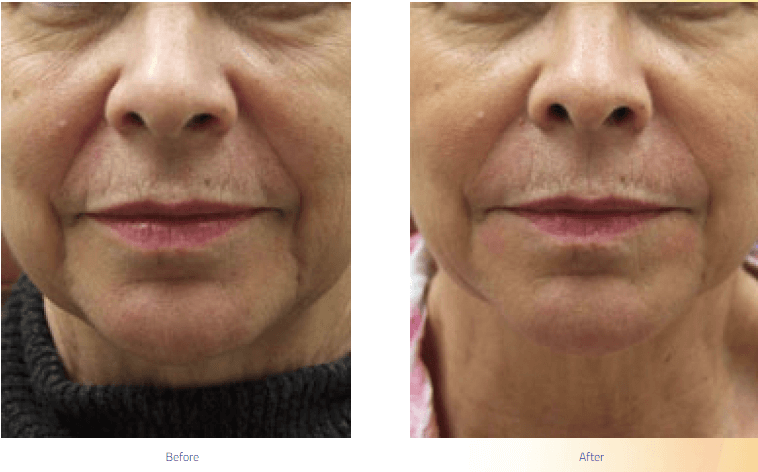 What Signs of Facial Aging can be Improved with Dermal Fillers?