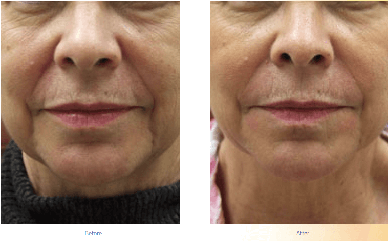 Dermal Fillers Results Guilford