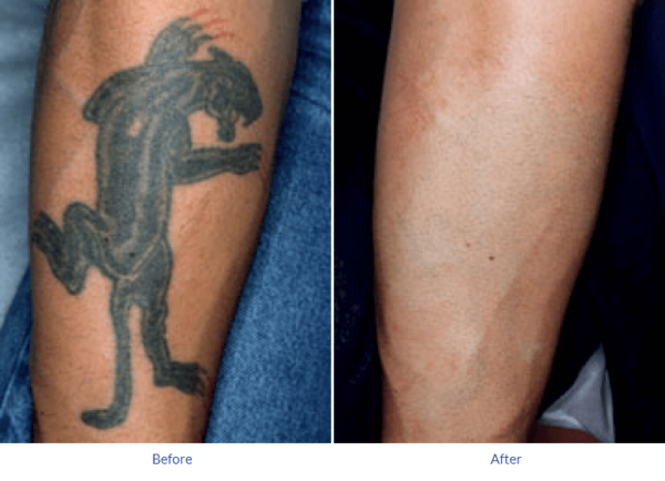 Tattoo Removal Cost Guilford