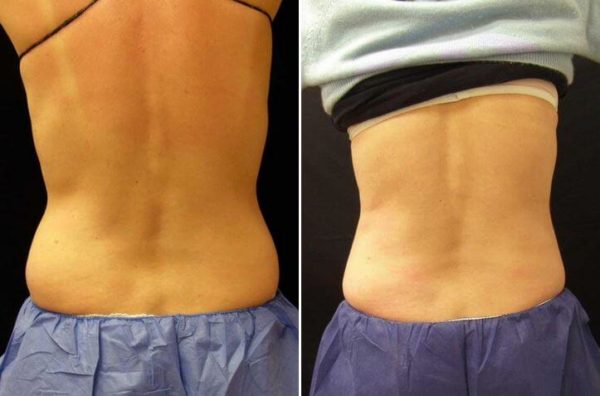 Coolsculpting Before & After Photo Guilford