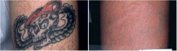 laser tattoo removal before & after photo Guilford