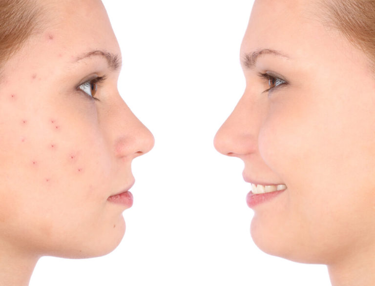 LaserClear: the Drug-free Solution for Moderate to Severe Acne