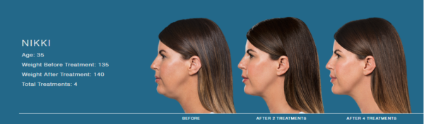 Kybella Cost Guilford - the Langdon Center Kybella Cost Guilford