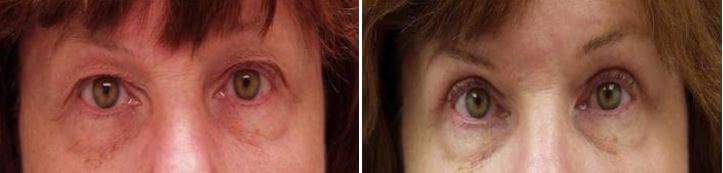 How Much Does A Blepharoplasty Cost?