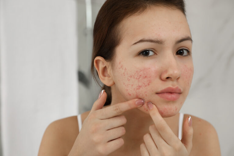 What Is The Best Treatment For Moderate – Severe Acne?