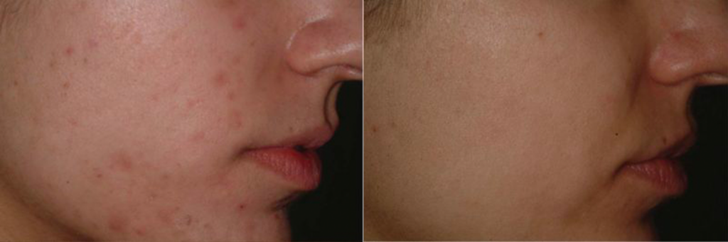 Laser Care at Guilford & Madison Connecticut whyLaserCare-before-after