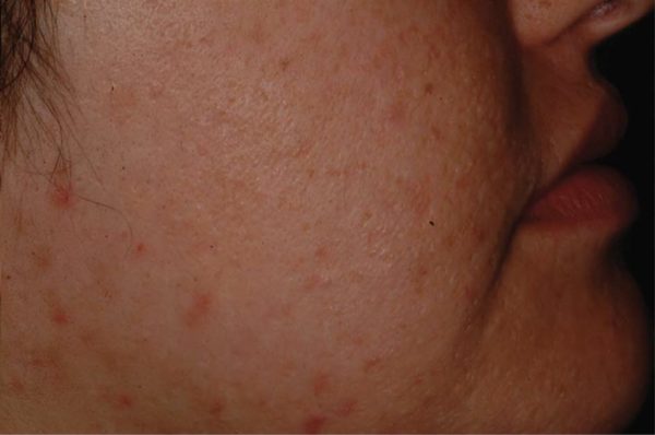 Treatment LaserClear Guilford, CT