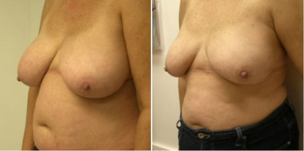 breast reduction surgery before & after photo-Guilford