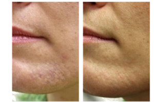 Acne Scare Treatment Guilford Ct