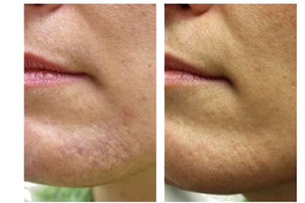 Acne Scare Treatment Guilford CT