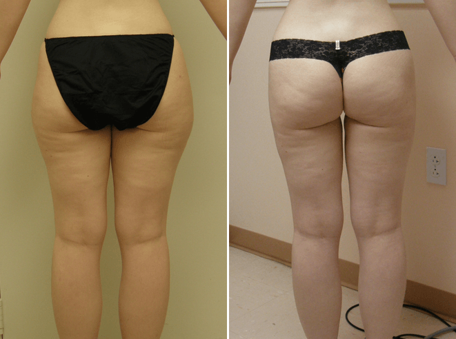 Liposuction Guilford CT