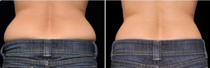 Coolsculpting Guilford, Ct