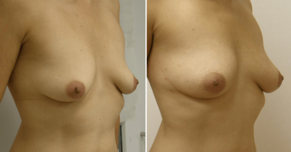 Natural Breast Augmentation Guilford, Ct
