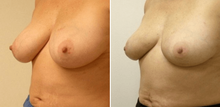 No-scar Breast Reduction Connecticut Guilford