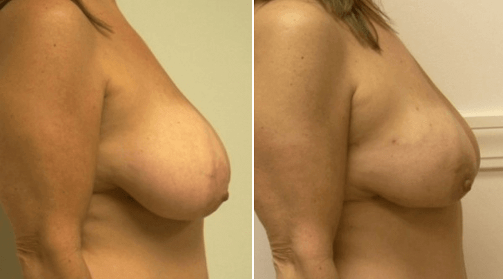 Breast-Reduction-Guilford