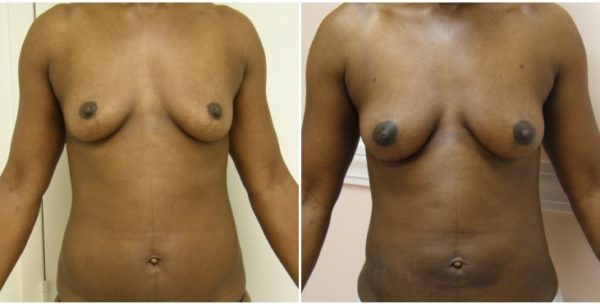 Guilford Breast Augmentation