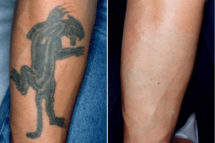 Laser Tattoo Removal Guilford Connecticut