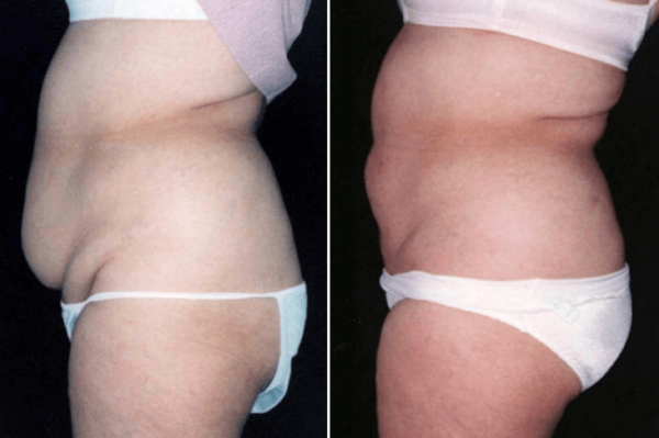 Liposuction Guilford