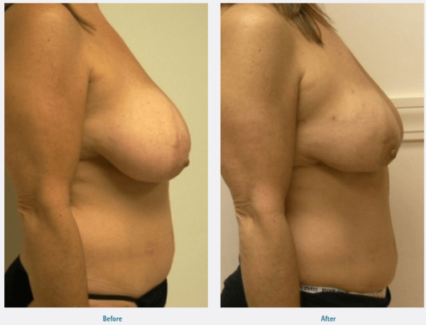 breast reduction without scars Connecticut