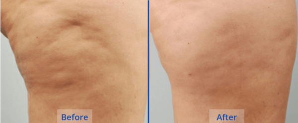 Cellulite Reduction Guilford